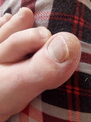 шелушение кожи возле ногтя